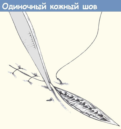 одиночный шов на рану